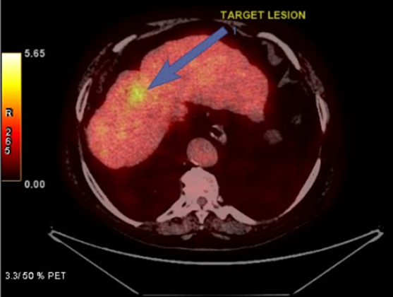 Radioembolization