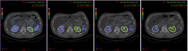 SPECT/CT showing 4 time points